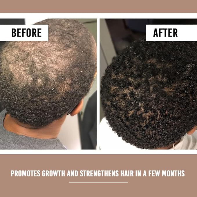 Hair Growth Serum, Hair Treatment For Women 1 FL Oz (30 mL) (Pack Of 1)