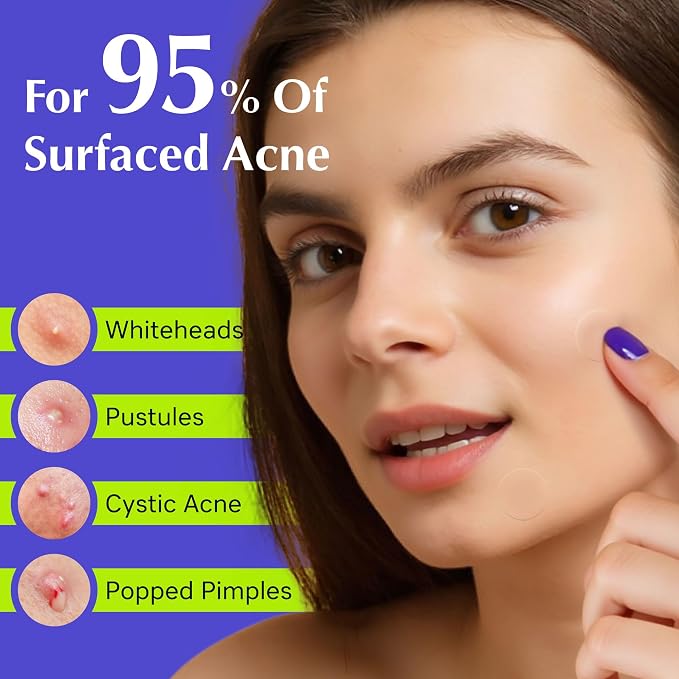 Pimple Patches For Face, Invisible Hydrocolloid Acne Patches Acne Treatment,Covering Zits & Blemishes in Skin and Face, Zit Patches with Salicylic Acid, FSA Eligible Items 48 Count