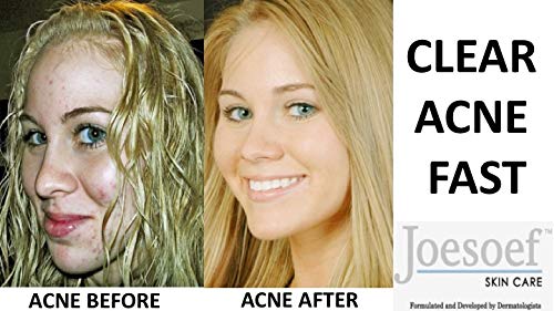 JOESOEF SKIN CARE Sulfur Soap with Salicylic Acid for Acne