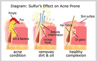 JOESOEF SKIN CARE Sulfur Soap with Salicylic Acid for Acne