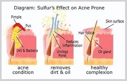 JOESOEF SKIN CARE Sulfur Soap for Acne Pharmaceutical Grade Dermatologists Approved for Acne Rosacea 100G