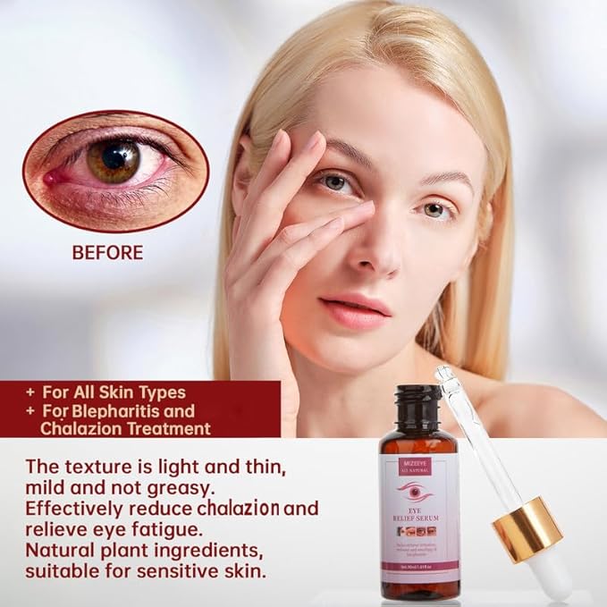 Styes Eye Relief Serum, 30ml Moisturize Blepharitis & Chalazion Remover, Gentle Under Eyelid Serum For Dark Circles, Puffiness.