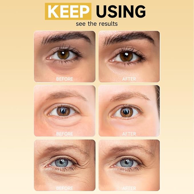 4 Pairs 5% PDRN Under Eye Patches, 6-in-1 Bio-Collagen 360° Eye Patches for puffy eyes, dark circles & Wrinkle | 2% Caffeine, Kojic acid, Retinol, Hyaluronic, Niacinamide | Korean Popular Eye Mask