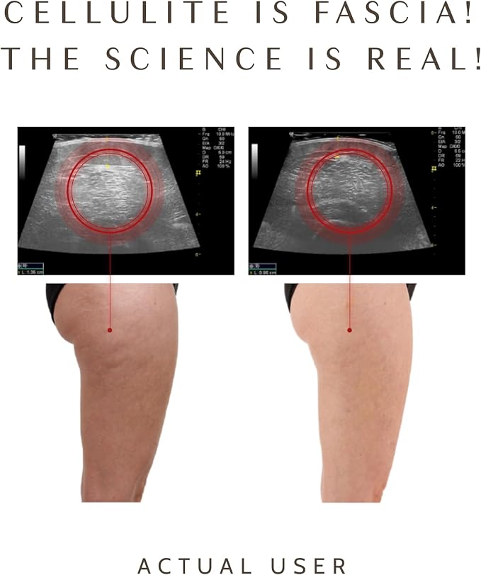 Ashley Black’s FasciaBlaster Trigger Point Fascia Tools for Recovery, Anti-Cellulite and Skin Soothing (FasciaBlaster)