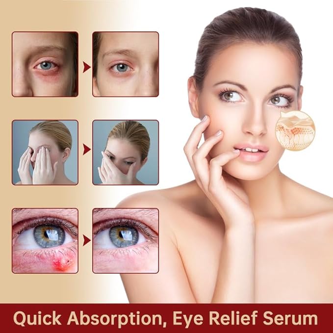 Styes Eye Relief Serum, 30ml Moisturize Blepharitis & Chalazion Remover, Gentle Under Eyelid Serum For Dark Circles, Puffiness.