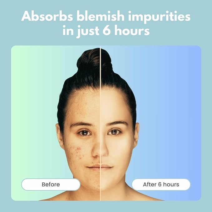 Acne Patch – Invisible (72 Patches) | Hydrocolloid & Retinol for Clearer Skin