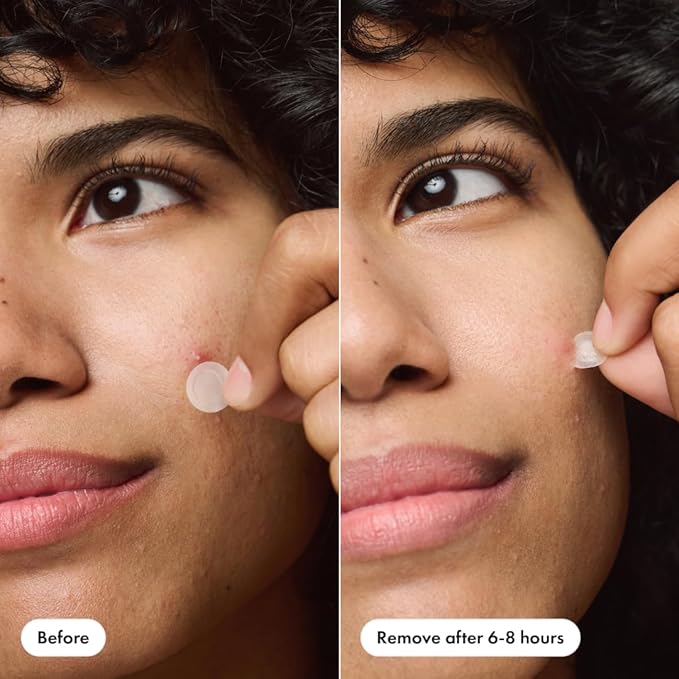 Mighty Patch™ Invisible+ Patch – The Barely-There Daytime Hydrocolloid Acne Pimple Patch for Covering Zits and Blemishes, Tapered Edges Designed to Blend Into Skin (72ct) (Pack of 2)