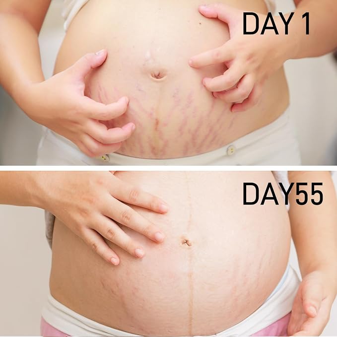 PEGO Stretch Mark Oil for Pregnancy, Maternity Body Oil for Stretch Mark Prevention & Reduction, Hydrating Skin Care, 2.03oz (1Pack)