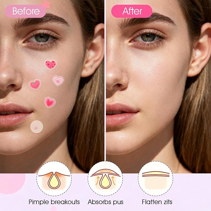 AUSLKA Star-Heart Pimple Patches for Face, Cute Zit Patches for Trip, Holiday, Dates Makeup, Mixed Shapes Zit Stickers with Salicylic Acid 216 Pcs
