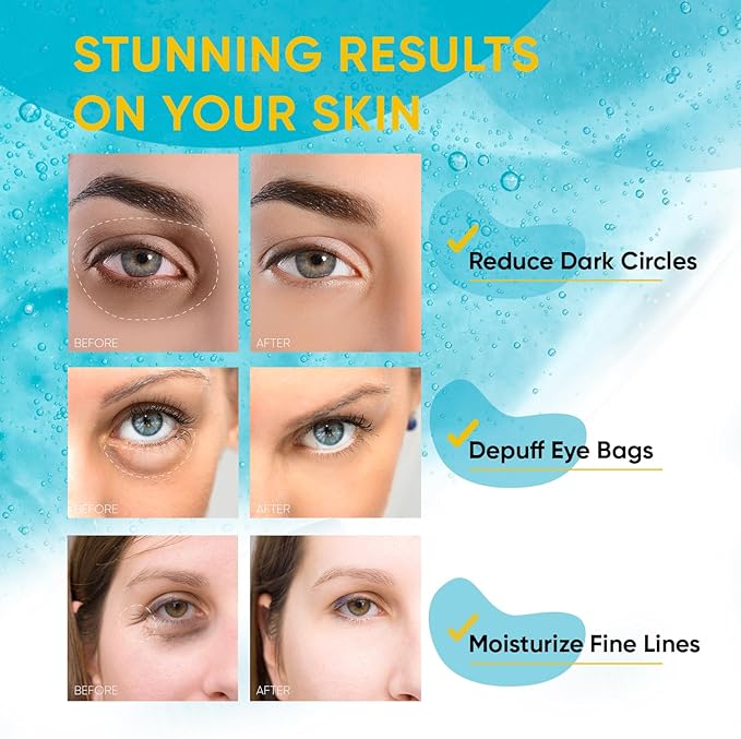 Under Eye Patches – 30 Pairs Hydrating Gel Masks with Collagen, Retinol & Albizia Bark | Helps Reduce Fine Lines, Wrinkles, Dark Circles, Puffiness & Eye Bags