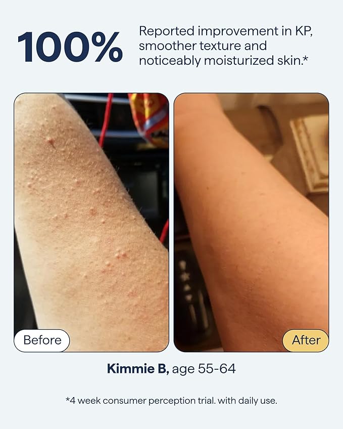 Remedy for Body Bumps | KP Exfoliating Body Moisturizer | Keratosis Pilaris (KP) Treatment For Textured, Crepey Skin with Urea, Lactic Acid, Retinol | Smoothing Body Lotion | By Dermatologist Dr. Shah