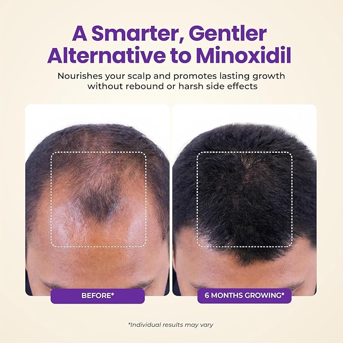 Thickening Hair Growth Serum for Women & Men (2Pack), Biotin Collagen & Rosemary Scalp Serum for Hair Density & Hydrating, Densifying Hair Serum Regrowth Oil for Hair Loss