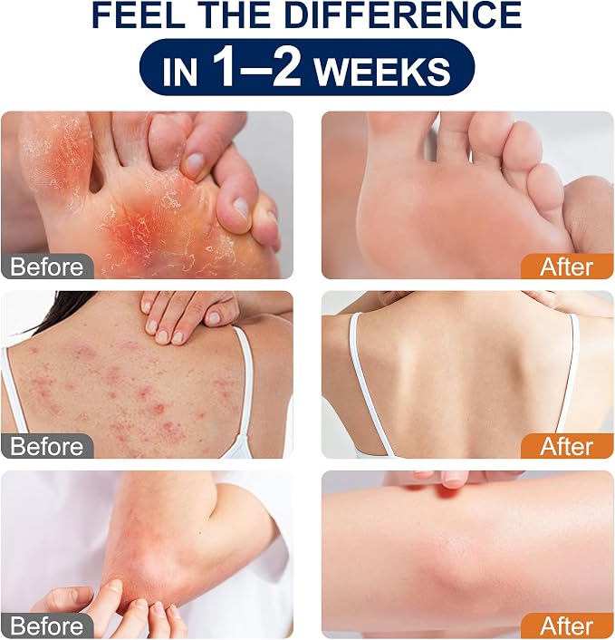 Antifungal Cream for Jock Itch, Athletes Foot & Ringworm - 2% Miconazole Nitrate Cream for Humans Skin Fungus, Relieves Itching, Burning, Cracking and Scaling (3.5 Ounce)
