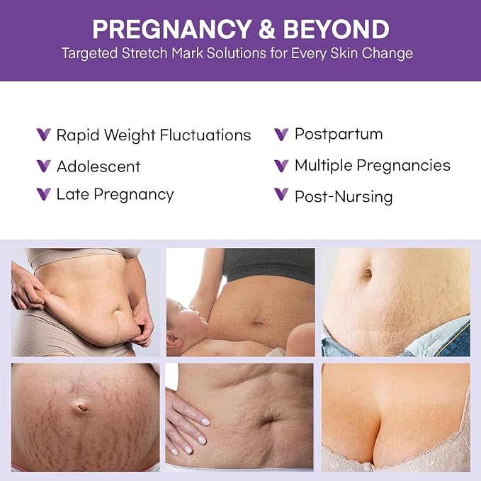 Stretch Mark Cream for Pregnant Women: Stretch Mark Treatment for Pregnancy - Belly Butter For Pregnant Women - Massage Lotion To Prevent And Repair Maternity Stretch Marks Scar - 4 Oz