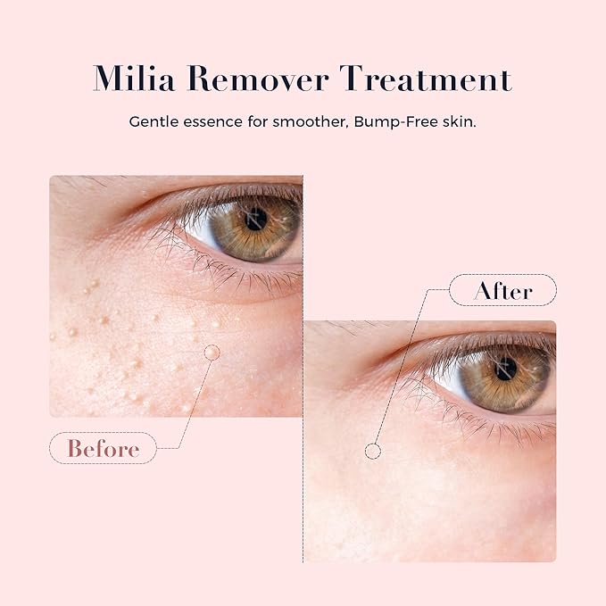 Milia Remover for Eye & Face, Milia Spot Treatment Serum with Salicylic Acid,Milia Acne Cream