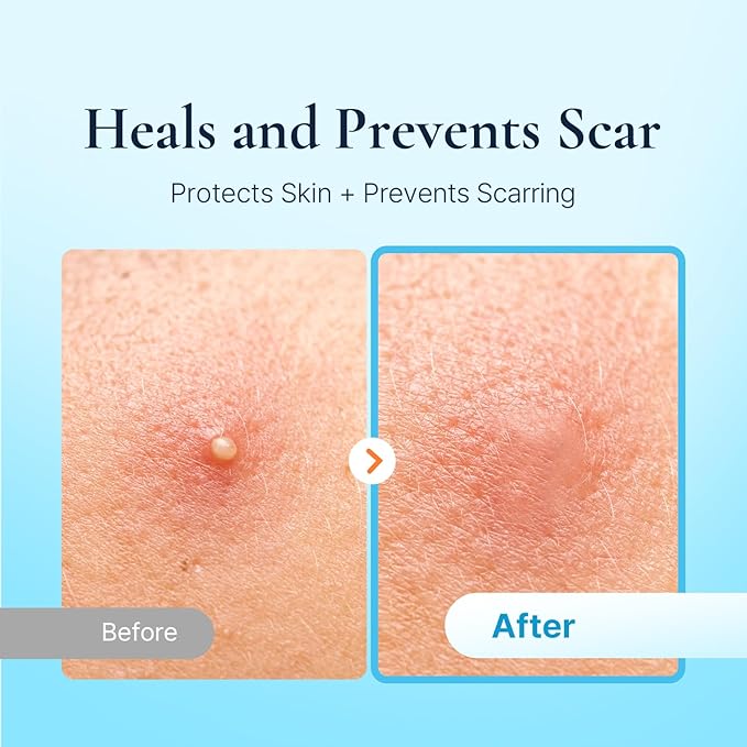 Discreet Acne Pimple Patch | Spot Cover Solution | Hydrocolloid Facial Stickers | Waterproof Patches Invisibly Cover Pimples