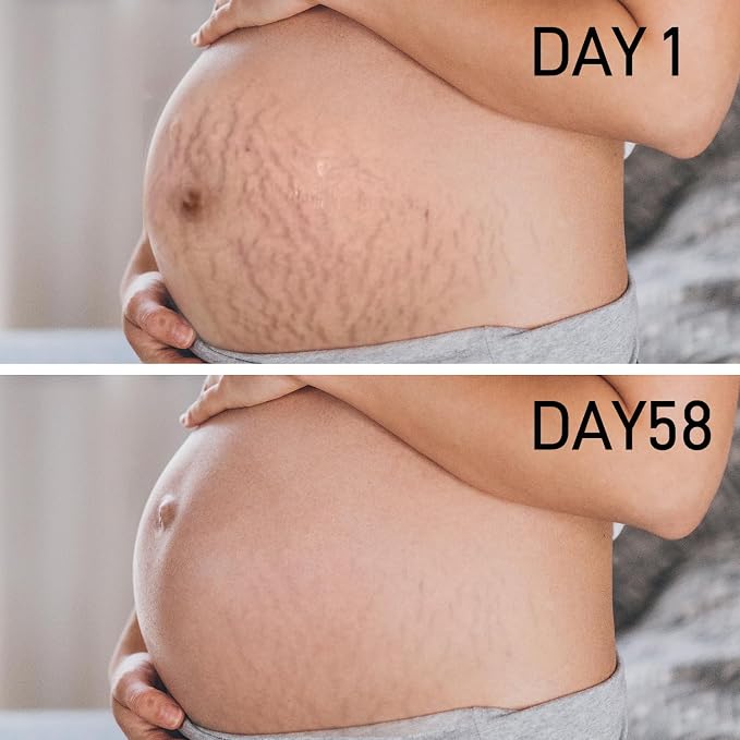 PEGO Stretch Mark Oil for Pregnancy, Maternity Body Oil for Stretch Mark Prevention & Reduction, Hydrating Skin Care, 5.41oz (Oil+Cream)