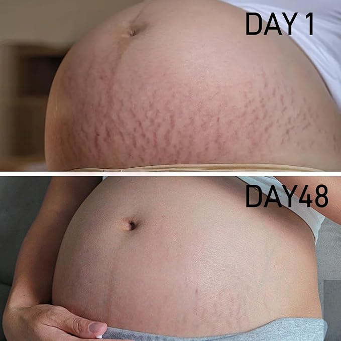 PEGO Stretch Mark Oil for Pregnancy, Maternity Body Oil for Stretch Mark Prevention & Reduction, Hydrating Skin Care, 4.06oz (2Pack)