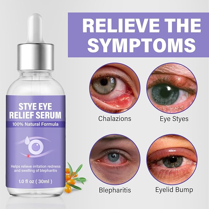 Stye Eye Treatment, Natural Stye Eye Drops for Chalazion and Blepharitis Relief, Gentle Daily Eye Care, Soothes Irritation Redness and Swelling, 1 Fl Oz / 30 Ml