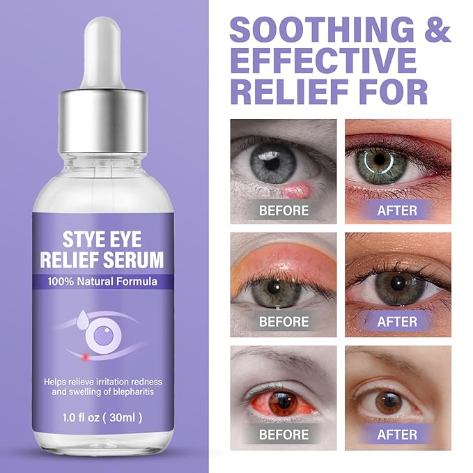 Stye Eye Treatment, Natural Stye Eye Drops for Chalazion and Blepharitis Relief, Gentle Daily Eye Care, Soothes Irritation Redness and Swelling, 1 Fl Oz / 30 Ml