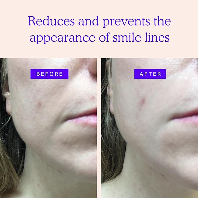 BLUMBODY Smile Line Patches – Face Wrinkle Patches for Fine Lines Around Mouth, between Eyes – Non-Silicone Anti-Wrinkle Facial Tape – Comfortable Overnight Use (90-Day Supply)