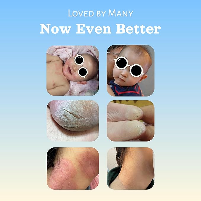 Natural SKIN REPAIR. Clinically tested Aromatherapy. Powerful Essential Oil. Eczema, Dermatitis, Diaper rash, and Sensitive skin. For all skin types. Hypoallergenic, Vegan, Paraben Free. 50ML TUBE