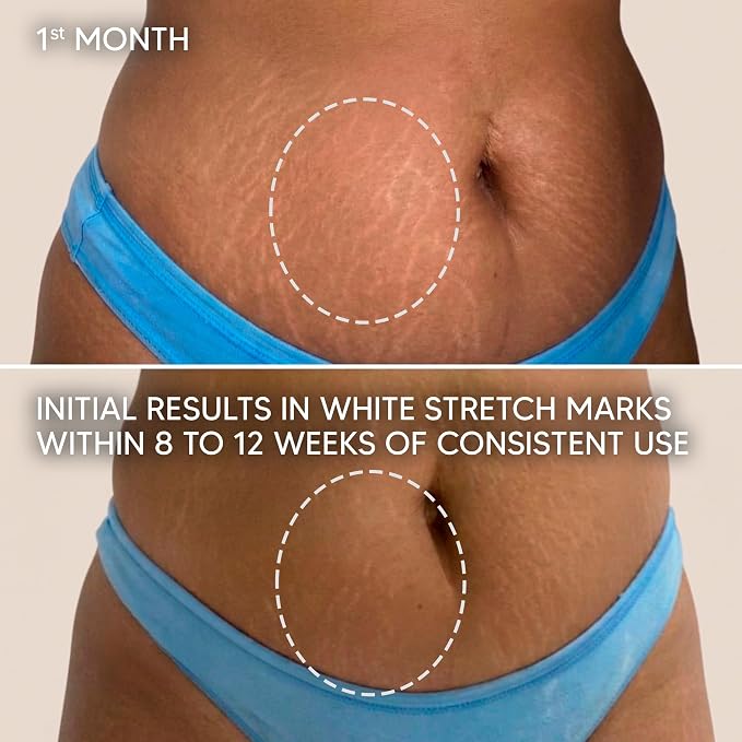 Cicatrissim Targeted Stretch Mark Cream for White and Established Striae - Softens Stretch Marks, Evens Skin Tone, and Supports Firmer Skin - All Skin Types - 5.3 oz