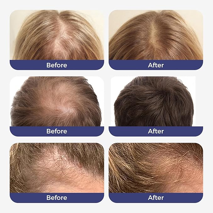 Hair Growth Serum Roll On,3% Rosemary, 6% Batana oil,3% Redensyl & 2% Anagain| No-Rinse, Fast-Absorbing | For Thinning Hair & All Hair Men & Women (1 Pcs)