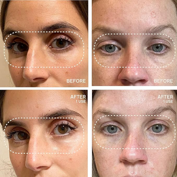 Dermaclara Eye & Mouth Patches- Anti-Wrinkle Silicone Patches for Smile Lines & Under Eye, Overnight Face Pads for Women & Men for Laugh & Frown Lines, Anti Aging, Reusable up to 30 Times - 4 Patches
