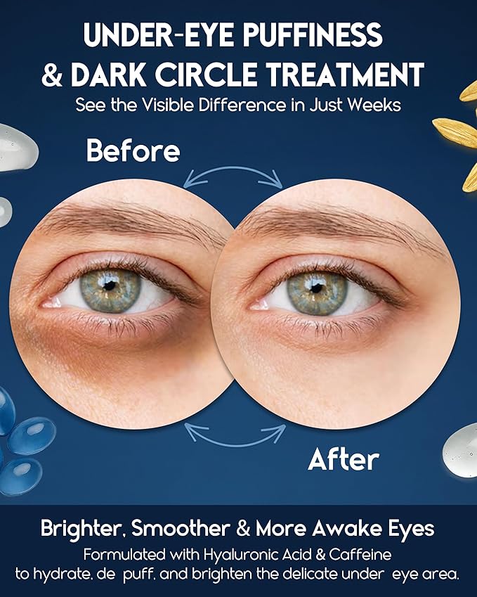Under Eye Cream for Puffiness and Bags Under Eyes - Eye Bags Treatment for Men & Women - Anti Wrinkle Cream for Dark Circles, Baggy Eyes Treatment for Women with Retinol, Hyaluronic Acid & Caffeine