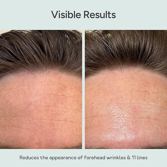 Reusable Silicone Anti-Wrinkle Patches for Forehead & Frown | Hypoallergenic, Moisturizing & Hydrating Patches for Creases, Fine Lines & Expression Lines | 2 pack (2 sets) | Up to 20 Uses