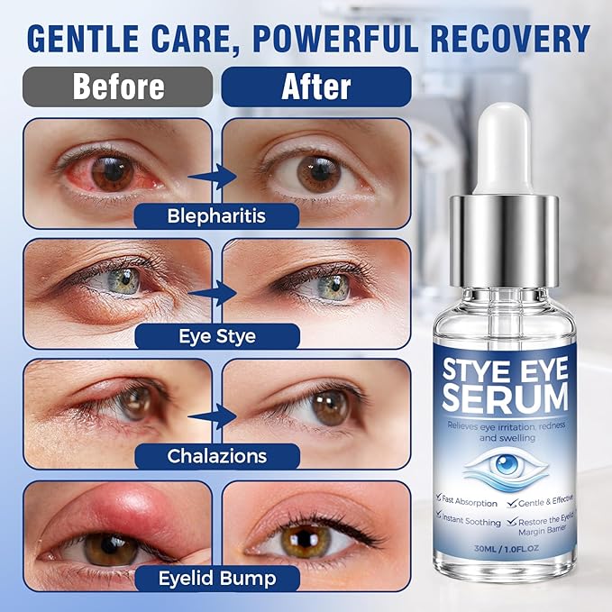 Stye Eye Treatment, Natural Relief Serum for Styes, Chalazions and Blepharitis, Blepharitis Treatment for Eyelids, Quickly Relieves Eyelid Irritation and Restores Healthier Skin, 30ML
