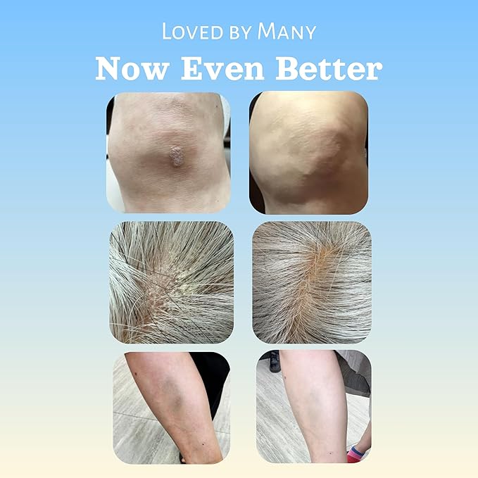Natural SKIN REPAIR. Clinically tested Aromatherapy. Powerful Essential Oil. Eczema, Dermatitis, Diaper rash, and Sensitive skin. For all skin types. Hypoallergenic, Vegan, Paraben Free. 50ML TUBE