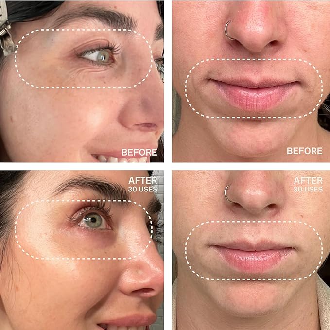 Dermaclara Eye & Mouth Patches- Anti-Wrinkle Silicone Patches for Smile Lines & Under Eye, Overnight Face Pads for Women & Men for Laugh & Frown Lines, Anti Aging, Reusable up to 30 Times - 4 Patches