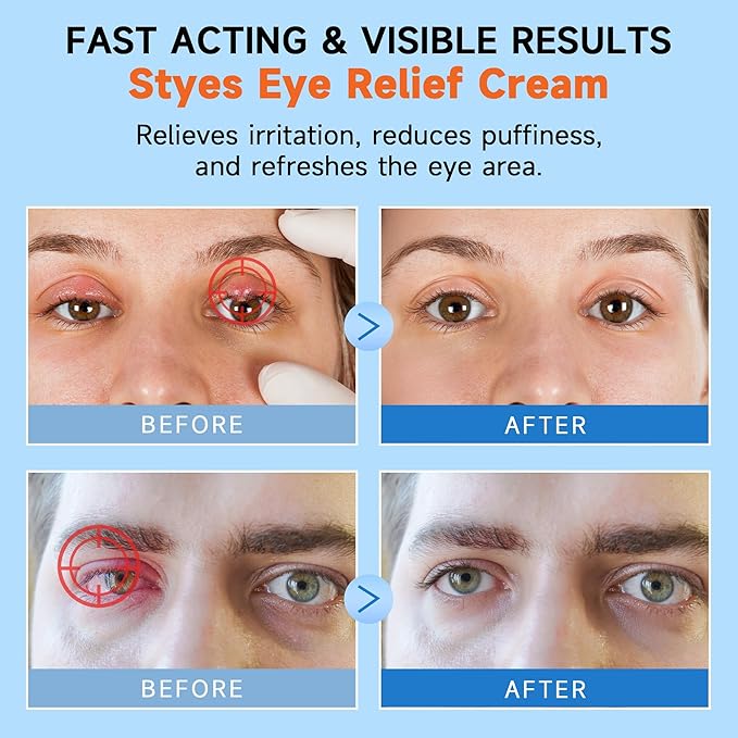 Stye Eye Relief Gel with Tea Tree Oil,Calendula & Vitamin E–Gentle Soothing Serum for Styes,Chalazion & Blepharitis,Soothing Eyelid & Under Eye Care for Redness,Irritation & Puffiness,1.4oz,2PCS