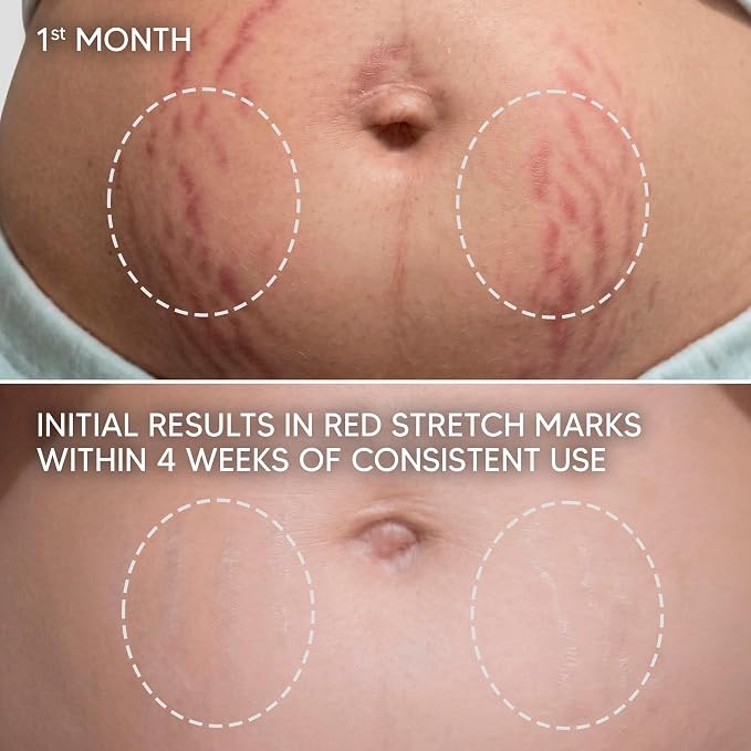 Cicatrissim Targeted Stretch Mark Cream for Red, Purple, and Recent Striae - Softens Stretch Marks, Evens Skin Tone, and Supports Firmer Skin - All Skin Types - 5.3 oz