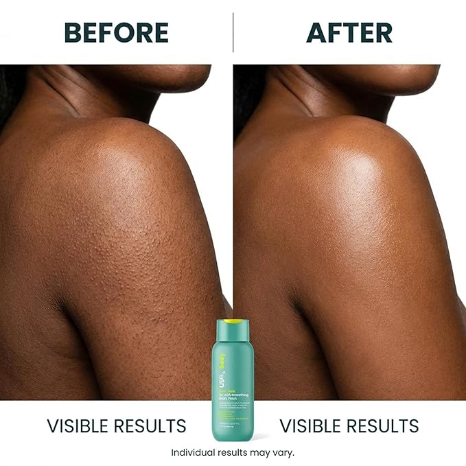 Urban Skin Rx Even Tone 5% AHA Smoothing Body Wash, Lathering Gel Formula, Deeply Cleanses, Soothes & Improves Appearance of Bumpy Texture, Blemishes & Uneven Skin Complexion, Daily Use, 13 Fl Oz