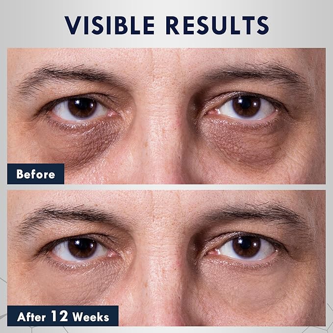 Eye Bags Treatment for Men, Caffeine Eye Serum for Men with Cooling Roller, Mens Eye Cream for Dark Circles and Puffiness, Under Eye Cream for Men, 2-Pack