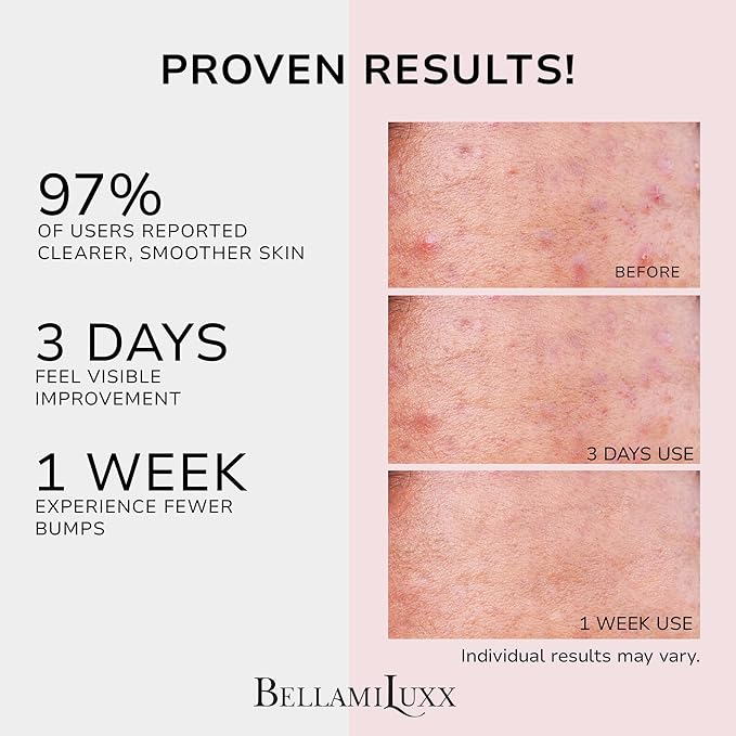 BellamiLuxx Butt Acne Clearing Treatment Cream: Body Acne Treatment Lotion for Folliculitis and Pimples on Back, Buttocks, Thighs With 2% Salicylic Acid & Tea Tree Oil - Butt Cream for Smooth Skin
