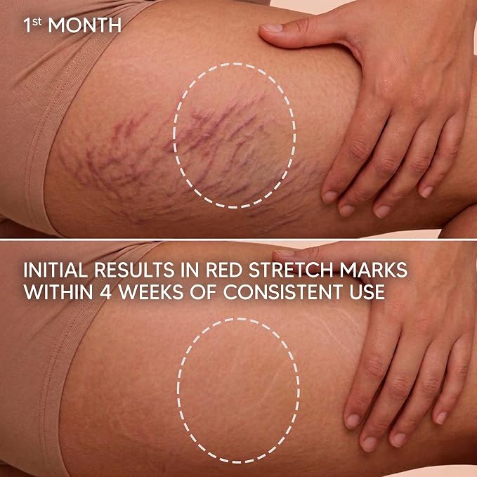 Cicatrissim Targeted Stretch Mark Cream for Red, Purple, and Recent Striae - Softens Stretch Marks, Evens Skin Tone, and Supports Firmer Skin - All Skin Types - 5.3 oz