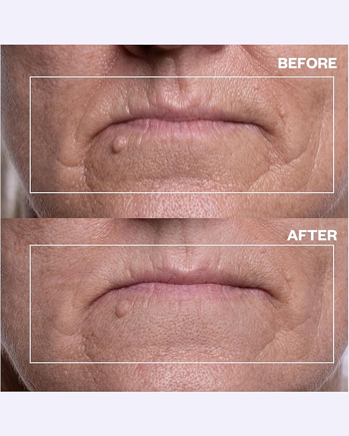 Wrinkles Schminkles Eye & Mouth Lift Set, Mouth & Lip Wrinkle Patch 2-Pack & Eye Wrinkle Patches 3-Pairs, Reusable Medical Grade Silicone Smile Line Patches, Anti Wrinkle Sleep Patches