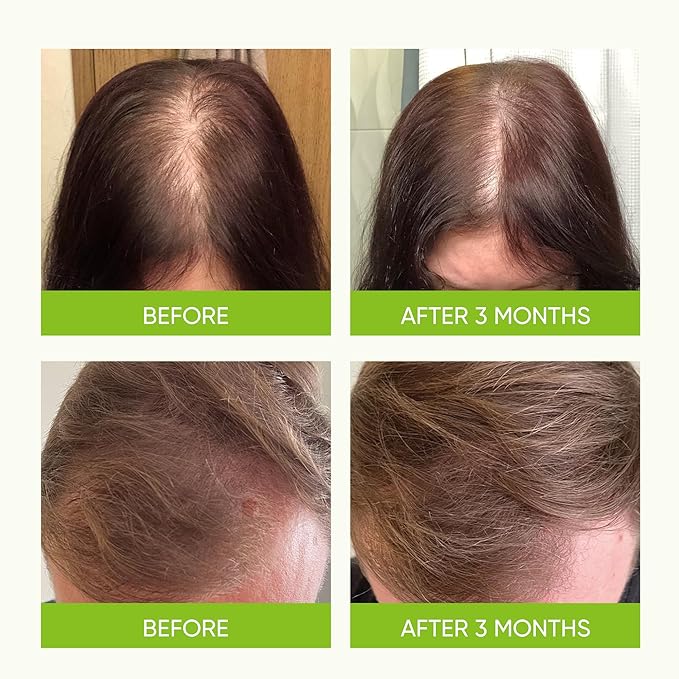 Svvimer Hair Growth Serum Spray - with Rosemary Batana Oil Biotin for Hair Loss and Thinning Hair - Thicker Fuller Hair for Women Men 2 Fl Oz (Pack of 1)